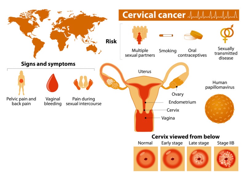 cervical-cancer-info