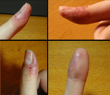 Fingertips_of_a_dermatophagia_sufferer