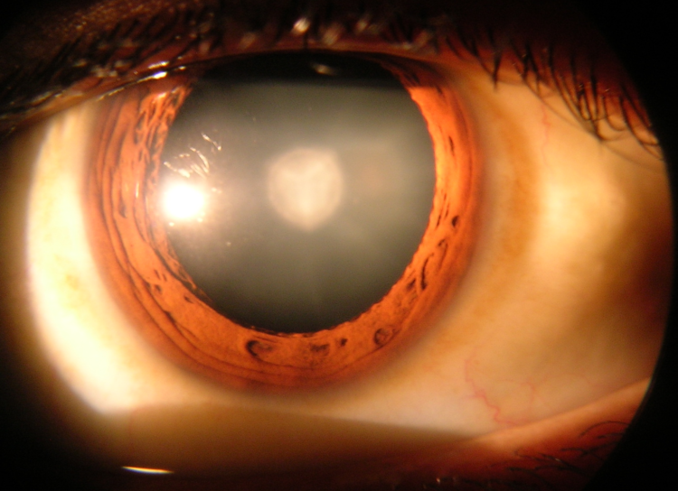 Cataract_in_human_eye-750x544