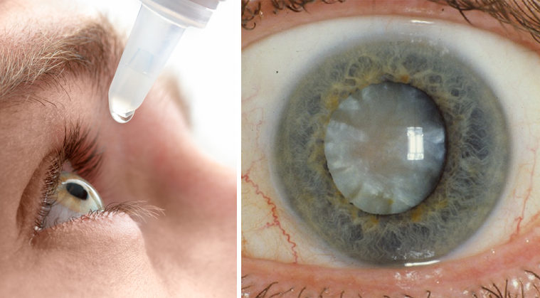 eye-drop-cataract-FI-759x419