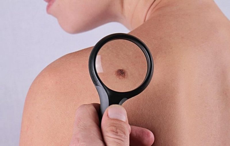 skin-cancer-symptoms-opener