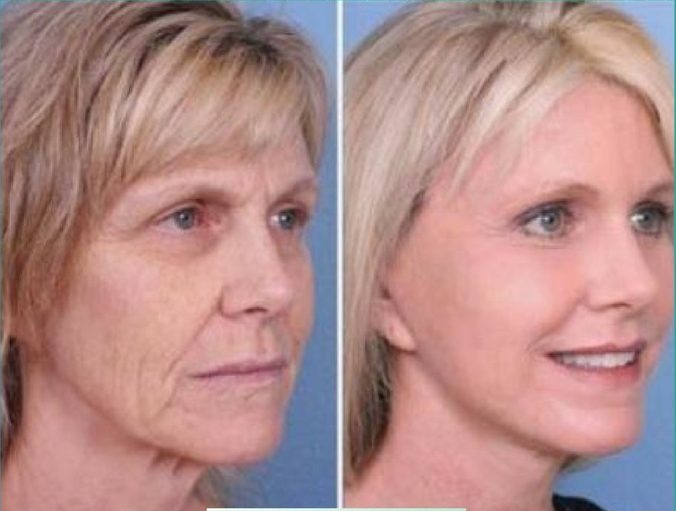 LOSE-15-YEARS-FROM-YOUR-FACE-IN-JUST-10-MINUTES-A-DAY