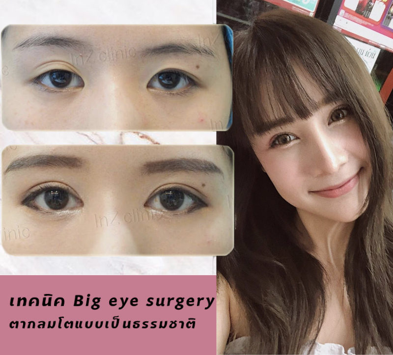 หมอศัลยกรรมตาที่เก่งที่สุดในไทย