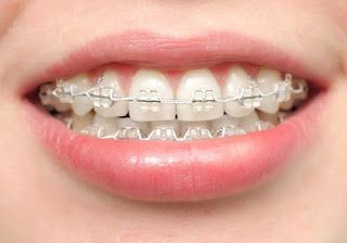 รวม 18 สีเหล็กดัดฟันที่ได้รับความนิยมมากที่สุด พร้อมวิธีดูแลฟันให้ขาว! –  Akeru