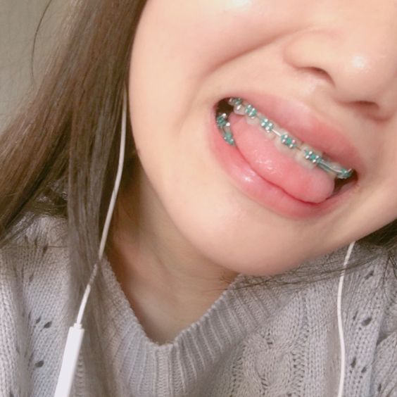 รวม 18 สีเหล็กดัดฟันที่ได้รับความนิยมมากที่สุด พร้อมวิธีดูแลฟันให้ขาว! –  Akeru
