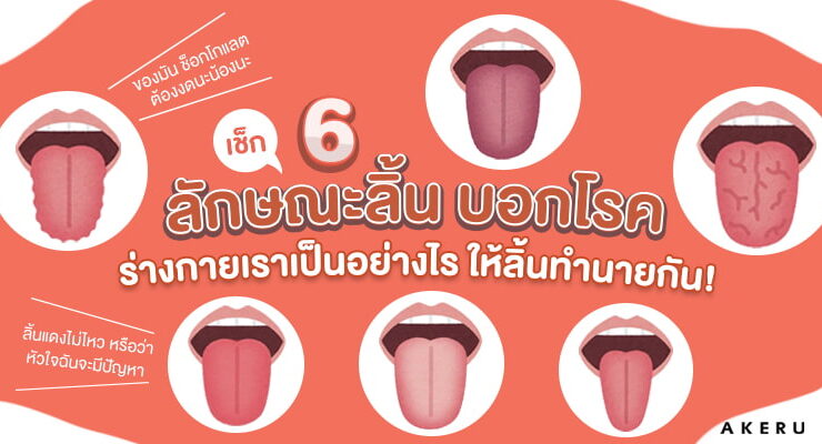 ลักษณะของลิ้นบอกโรค